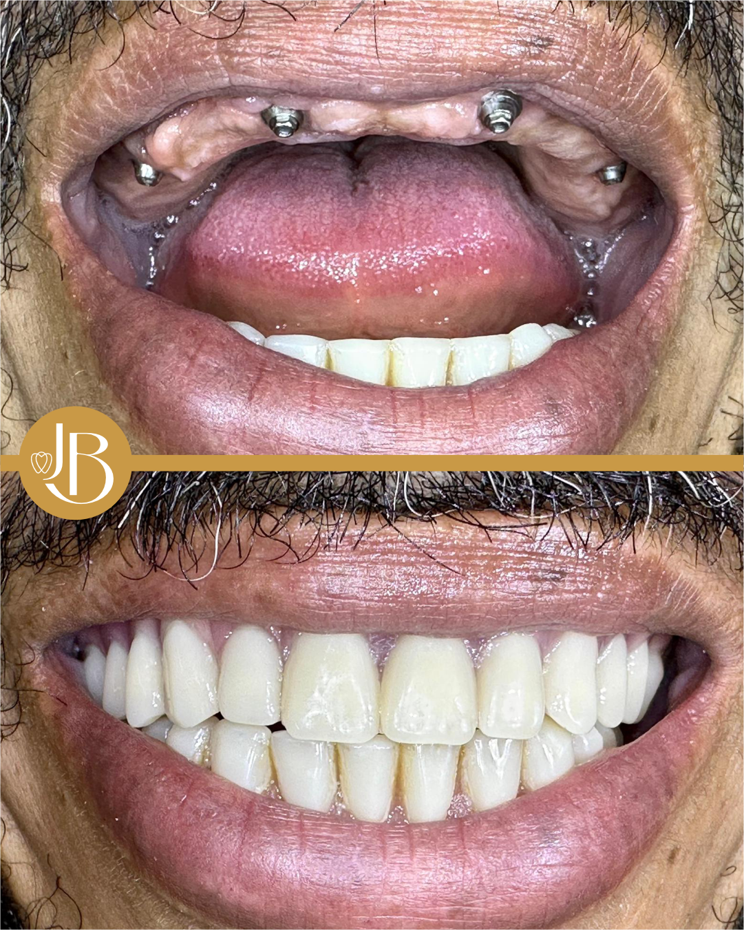 antes e depois 11